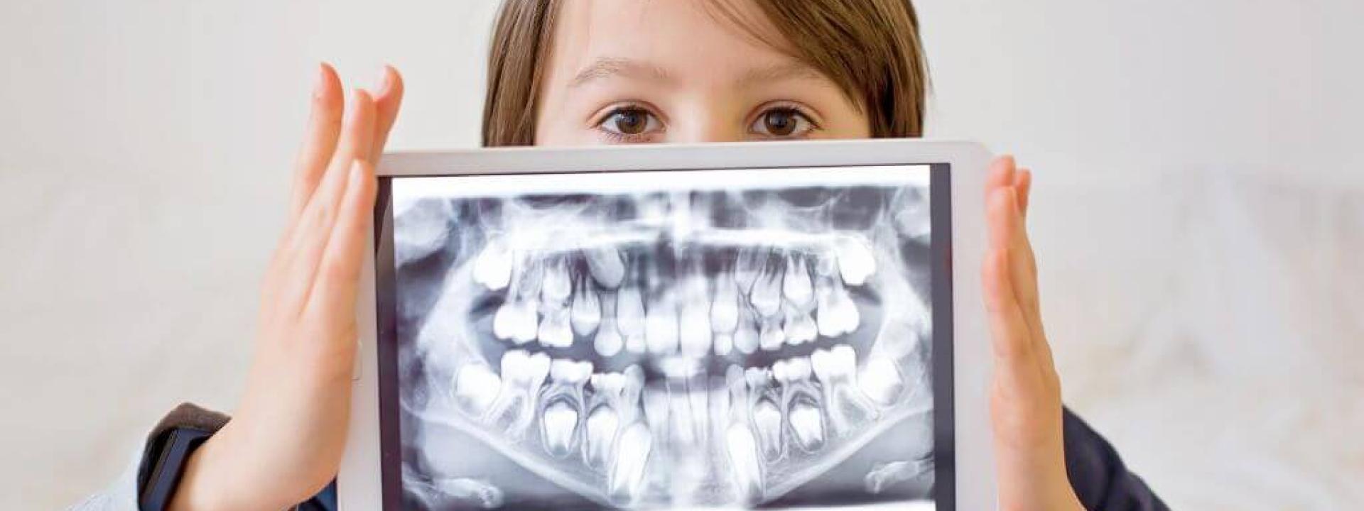 Dental X-Rays: 7 of Your Top Questions, Answered! Dental X-Rays: 7 of Your Top Questions, Answered!