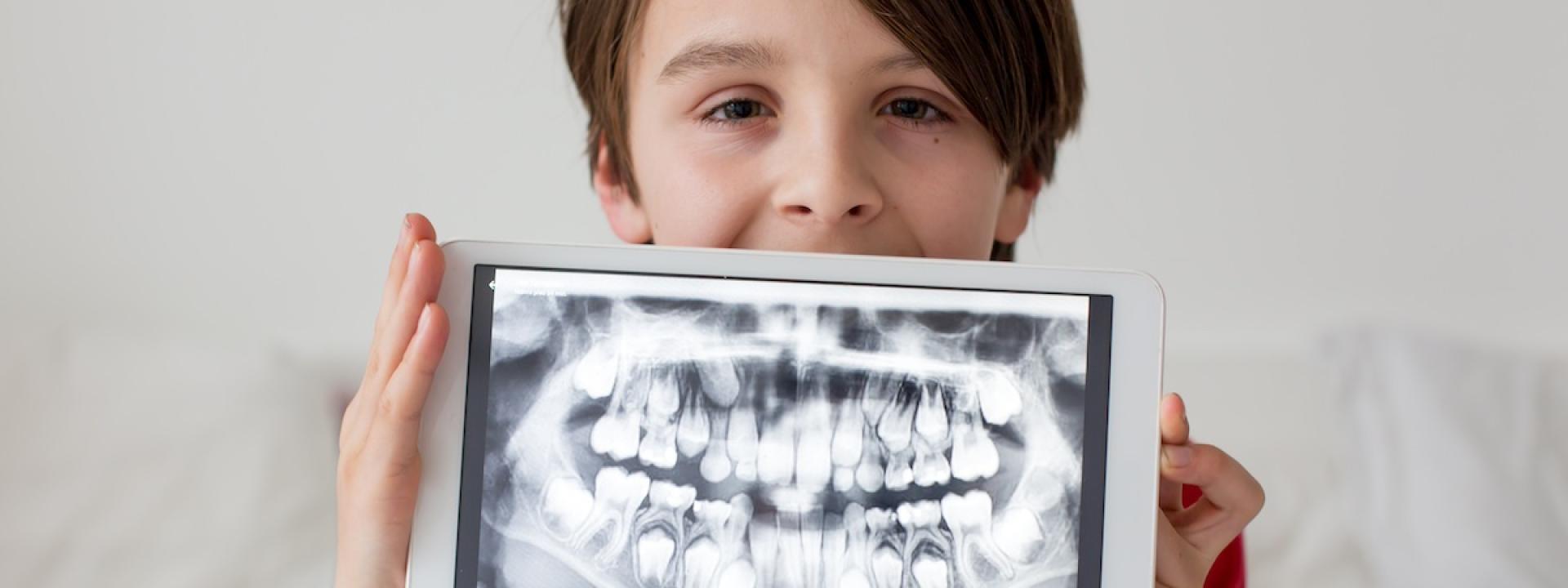 Dental X-Rays for Children Dental X-Rays for Children