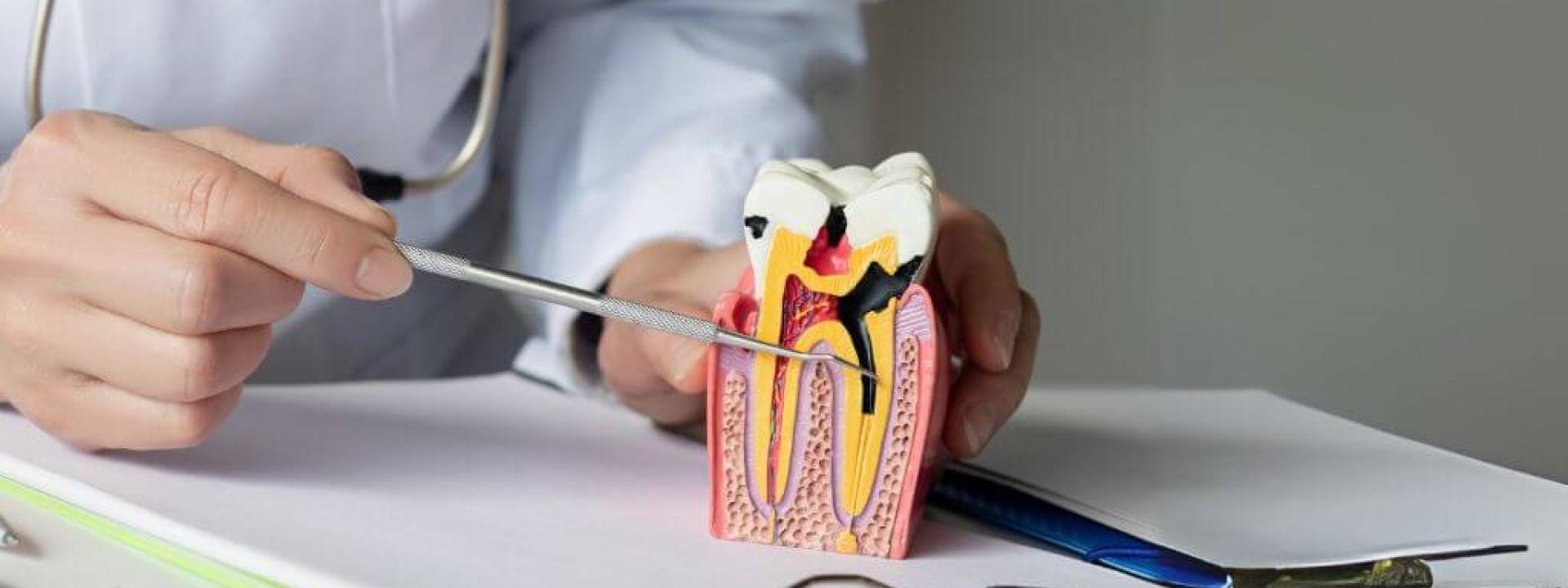 What to Expect During a Root Canal What to Expect During a Root Canal